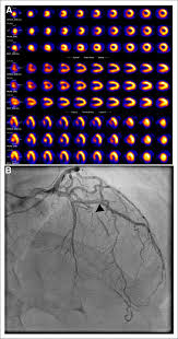 Any opinions in the examples do not represent the opinion of the cambridge dictionary editors or of cambridge university press or its licensors. Myocardial Perfusion Images From Patient Patient 99 In This Study Download Scientific Diagram
