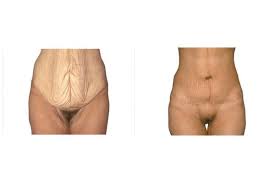 Maybe you would like to learn more about one of these? Bauchdeckenstraffung Uberschussige Haut Entfernen Dr Edvin Turkof