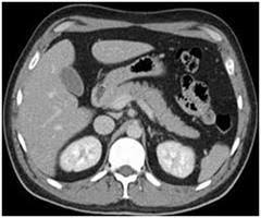 A typical contrast ct works by injecting contrast into a vein (it can also be administered orally to highlight the bowel or through the rectum). Getting Ready For Your Abdominal Ct Scan Sansum Clinic