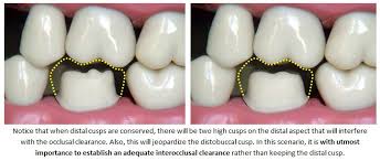 Image result for Occlusal