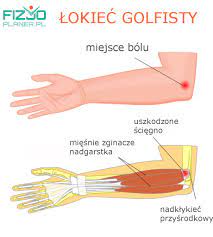 Jeśli podczas ściskania ręki przy przywitaniu odczuwasz ból, warto zgłosić się do specjalisty. Lokiec Golfisty I Lokiec Tenisisty Przyczyny Objawy Oraz Metody Leczenia Zachowawczego Fizjoplaner Pl