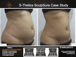 S Thetics Sculpsure Before And After Body Sculpting3 Aesthetic Clinic Medical Aesthetic Body Contouring