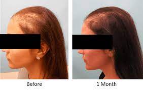 Maybe you would like to learn more about one of these? Stem Cell Therapy For Hair Loss Stemedix Regenerative Medicine Also Known As Stem Cell Therapy Stem Cell Treatment