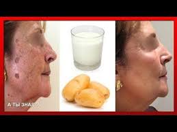 как избавиться от пигментных пятен на руках народными средствами Izbavites Ot Pigmentnyh Pyaten Yazvy Gastrita Ochistite Pechen S Kar S Izobrazheniyami Zdorove Lico Zhenskoe Lico