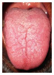 Image result for Fissured tongue