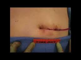 Image result for kidney surgery         girl
