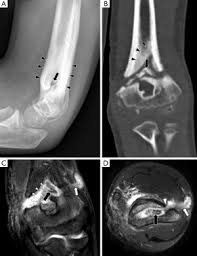 Image result for Osteomyelitis Bone Scan