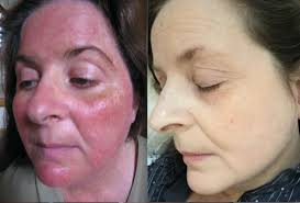 Résultat de recherche d'images pour "rosacea"