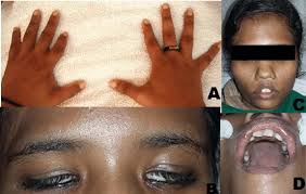 Image shows shortened index finger