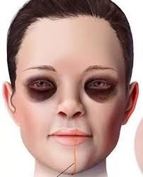 Patient presented after a fight with her husband with this appearance. What  is your diagnosis?