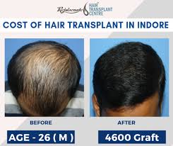 Bht (body hair transplant) is another form of fue hair transplant which allows surgeons to successfully extract the body hair follicles from the the difference in punch size by hair plugs vs fue is obvious. How Much Does Hair Weaving Cost In India
