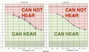 Types Of Deafness Ears Hearing Uk