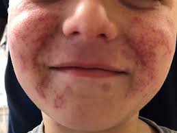 It's sometimes called actinic purpura. Petechial Rash On Face After Crying
