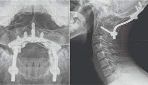 Rotatory Subluxation And Facet Deformity In The Atlanto Occipital Joint In Patients With Chronic Atlantoaxial Rotatory Fixation Two Case Reports Journal Of Orthopaedic Case Reports