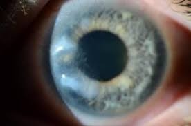 Image result for lesion sclera