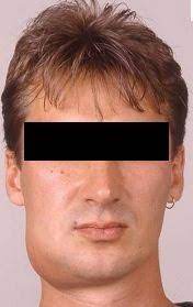 Abszess Und Fistel Furini Lorenz Zahnarzt Dentista Gais