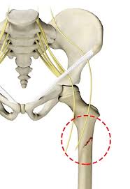 Image result for Femur Bone