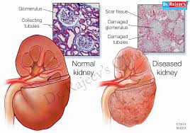 When systemic diseases and renal parenchymal diseases are excluded, there is a high possibility of urologic diseases such as malignant tumor diseases that may cause hematuria are broadly divided into three groups: Best Homeopathy Treatment For Chronic Kidney Disease