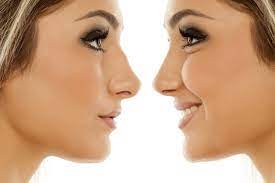 The upper portion of the structure of the nose is bone, and the lower portion is cartilage. Aesthetic Nose Surgery 4 Things To Look For In A Surgeon