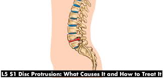 A herniated disc occurs when one of the spongy discs that cushion your spine becomes damaged, causing it to bulge or bust. L5 S1 Disc Protrusion Causes And Treatment Of Back Pain Caused By A Slipped Herniated Disc Youmemindbody