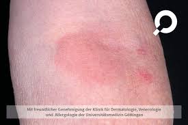 Image result for erysipel photos)