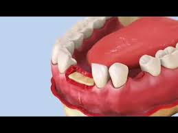 Yuk cabut gigi, gratis loh. Jenis Gigi Palsu Yang Ditanggung Bpjs