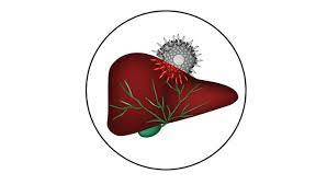 Hepatita c este o afectiune a ficatului, produsa de virusul hepatic c, care are ca efect distrugerea tesutului hepatic. Hepatita B Tot Ce Trebuie Sa Stii Reginamaria Ro