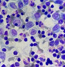 histology Breast. Woman, 45 years old. Difficult case. There is not  immunohistochemistry. What is your diagnosis? #histopathology #lab  #histopathologylab #mededucation #medicine #cytopathology #pathology