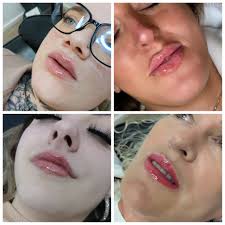 💋Lip filler 1ml just £100 for a limited time only!💋 Fully accredited &  insured aesthetics practitioner Canford Heath 📍 Tuesdays & Fridays Beauty  By Rachel Inkspiration Tattoo