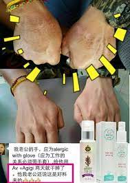 皮膚过敏有伤口 洗了 𝘼𝙥𝙥𝙥𝙡𝙚𝙑𝙞𝙘𝙩𝙤𝙧𝙮 𝘼𝙂𝙞𝙂𝙞 成功愈疗过敏症 迅速止癢 家里必备神器 agigi 湿疹 牛皮藓 皮肤敏感 割伤 消炎 快速止血 蚊虫叮咬