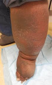 Image result for Localized Edema