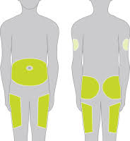 If the insulin vial is new, remove the cap. Injection Sites Mylife Diabetescare United Kingdom