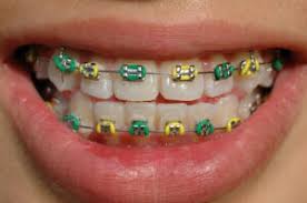 4.3 out of 5 stars. Choosing Colors For Your Braces Okc Braces Craig Streight