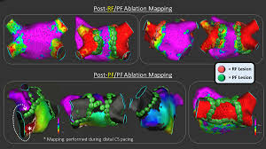Maybe you would like to learn more about one of these? Lattice Tip Focal Ablation Catheter That Toggles Between Radiofrequency And Pulsed Field Energy To Treat Atrial Fibrillation Circulation Arrhythmia And Electrophysiology