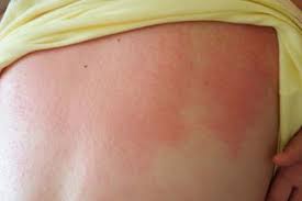 Image result for sweat rash on back baby