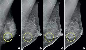 This condition usually does not develop a lump, but commonly affects the breast skin. 3 D Mammograms May Improve Accuracy Of Breast Cancer Screening