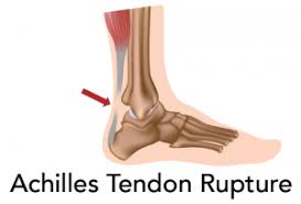 Achilles Tendon Repair Rehab Protocol Recovery Time Frame Achilles Tendon Ruptures Achilles Tendonitis Achilles