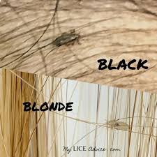 What do lice look like? Dealing With Head Lice Can Be Difficult For Anyone But It Can Be Especially Difficult For Those With Blonde Hair Whether You Are In 2020 Hair Lice Blonde Hair Louse