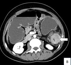 Nearly 140,000 people are diagnosed with colorectal cancer in america. A Case Of Progressive Abdominal Pain Leads To A Surprise Finding Medpage Today