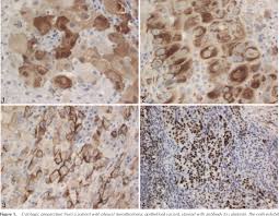 Check spelling or type a new query. Application Of Immunohistochemistry To The Diagnosis Of Malignant Mesothelioma Semantic Scholar