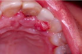Image result for granuloma gum disease