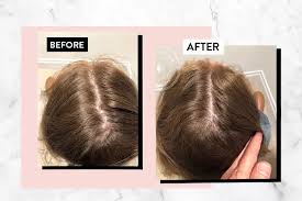 Wikipedia) nizoral shampoo may be used in conjunction with medical hair loss treatments. Byrdie Here Are My Honest Thoughts After Using Harklinikken For 8 Ful