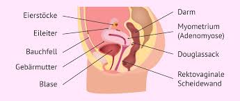 Endometriose ist eine häufige, gutartige, oft schmerzhafte chronische erkrankung von frauen, bei welcher der gebärmutterschleimhaut (dem endometrium) ähnliches gewebe außerhalb der gebärmutterhöhle (ektop) vorkommt. Die Endometriose Symptome Fruchtbarkeit Und Behandlung