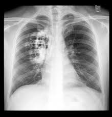 Image result for lung cancer xray