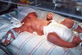 Clubfoot is a fairly common birth defect and is usually an isolated problem for an otherwise healthy newborn. Photos Of Babies With A Clubfoot