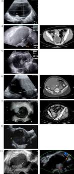 Also, endometriosis can cause cysts on the ovaries that may appear to be pelvic masses similar to ovarian cancer. Unexpected Epithelial Ovarian Cancers Arising From Presumed Endometrioma A 10 Year Retrospective Analysis Sciencedirect