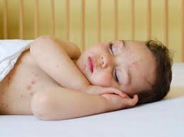 7 fiches de conseils complets et pratiques pour: Varicelle Roseole Scarlatine Que Faire