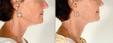 How Long Does a Facelift Last?