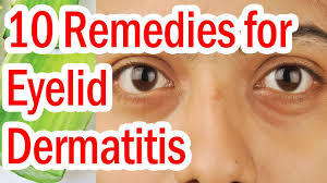 Approach to the patient with a scalp disorder, overview of benign lesions of the skin, seborrheic dermatitis in adolescents and adults. Top 10 Natural Remedies For Eyelid Dermatitis Youtube