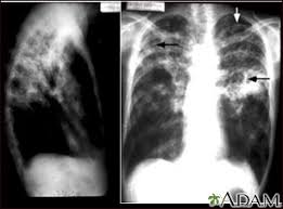 Other views (lateral or lordotic). Tuberculosis Advanced Chest X Rays Medlineplus Medical Encyclopedia Image